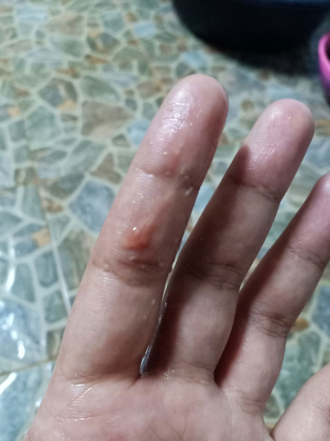 38week มีมูกเลือด แต่ไม่ปวดท้อง