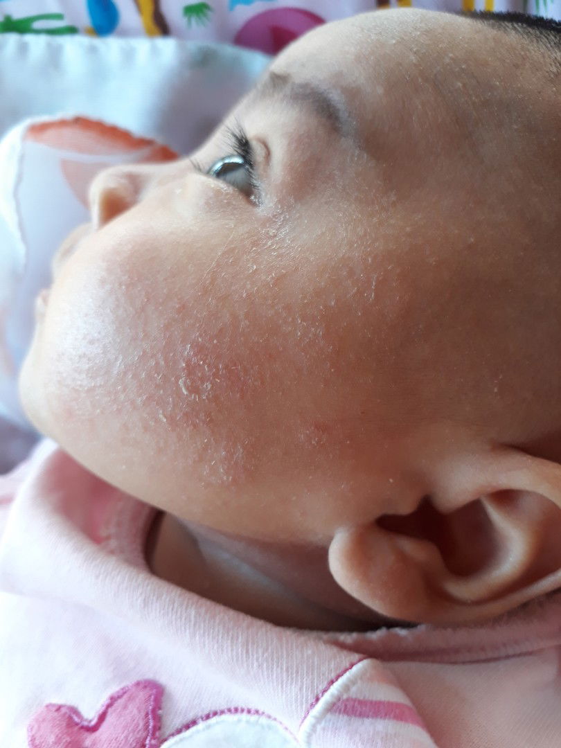 ผื่นที่แก้ม