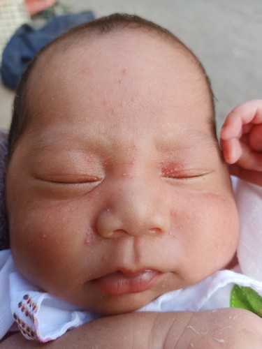 หน้าน้องเปนผื่นแบบนี้