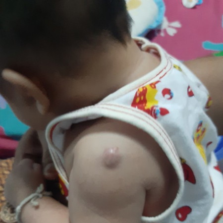 น้องเป็นฝี