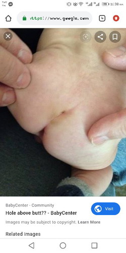 Sacral Dimple