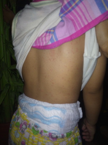rashes