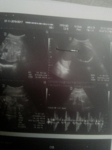 sino po pwd mag explain or makapagsabe po sken kung ano ung result ng ultrasound ko. if Normal po ba at healthy naman si baby