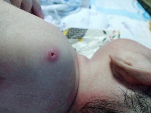 หมอปลูกฝีที่แขนลูก