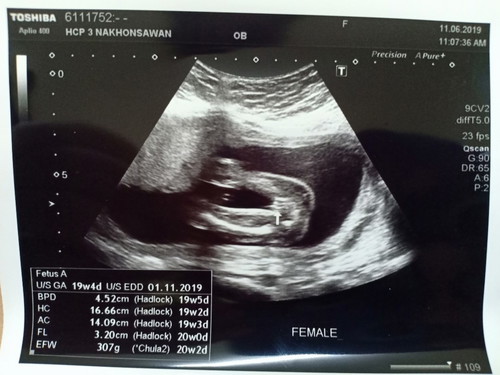20week 8d แล้ว