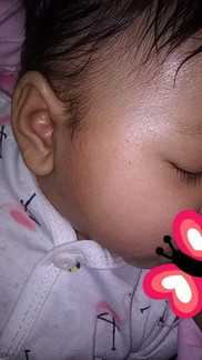 ruam susu