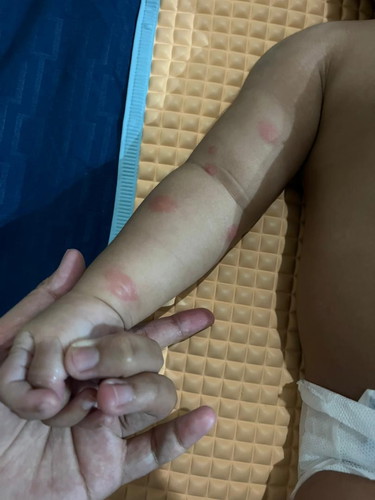 Tangan bintik merah