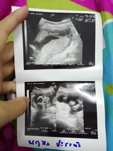 เส้นเอ็นในน้ำคร่ำ