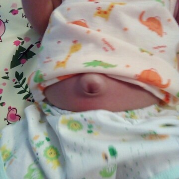 สอบถามค่ะสะดือน้องปูดแบบนี้จะเป็นอะไรไหมค่ะ