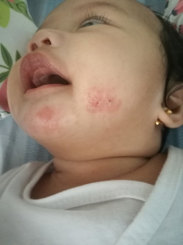 rashes