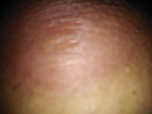 ท่อน้ำนมอุดตัน