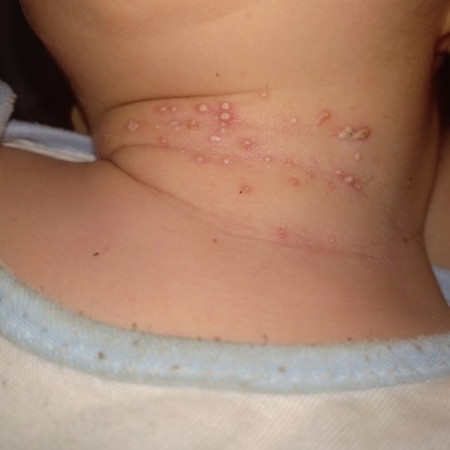 vai ngay trk bé bị hăm nhg thoa thước hết hăm nhg nổi mụn ntn.m nao bi chua ạ