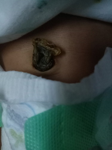 ลูกอายุ17วันแล้วค่ะแต่สะดือยังไม่หลุดและมีกลิ่น