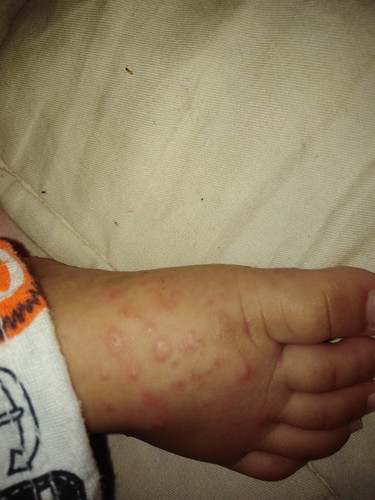 ผดหรืออะไร.งงค่ะ