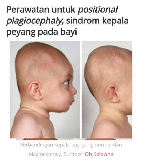 kepala bayi datar