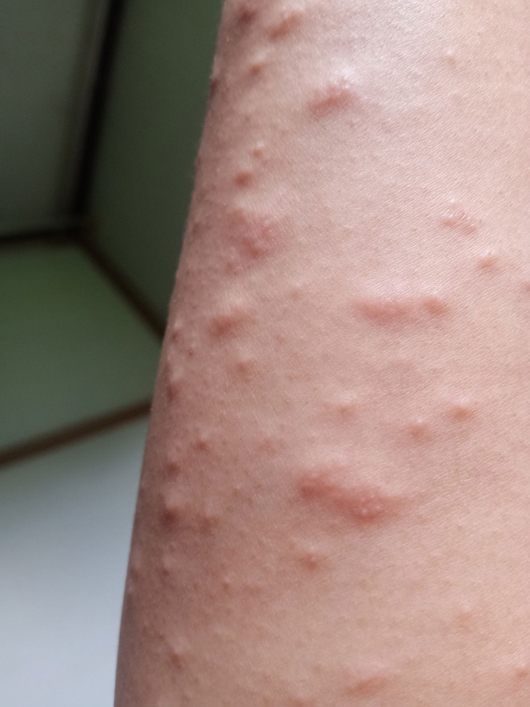 Gatal,bruntusan,merah