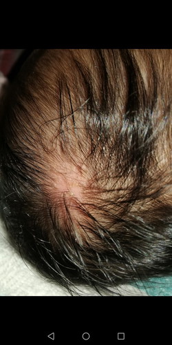hair loss