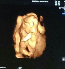 janin telungkup saat USG