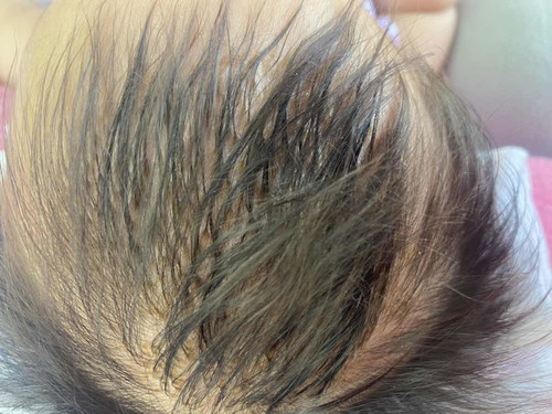 หัวน้องเป็นแบบนี้ทำยังไงหายค่ะแม่ๆ