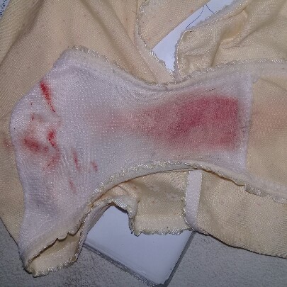 ภาวะแท้งคุกคาม