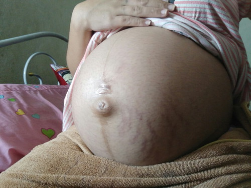 ท้องแตกลายหลังคลอดจะหายไหม