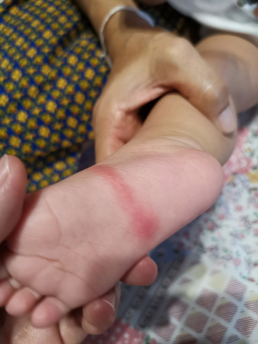 เช้านี้ ลูกมีตุ่มใต้เท้า เหมือนสัตว์กัด แต่มันเป็นทางยาวๆ ทำอย่างไรดีคะ