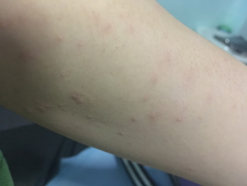 ตุ่มใสคั่นๆๆ