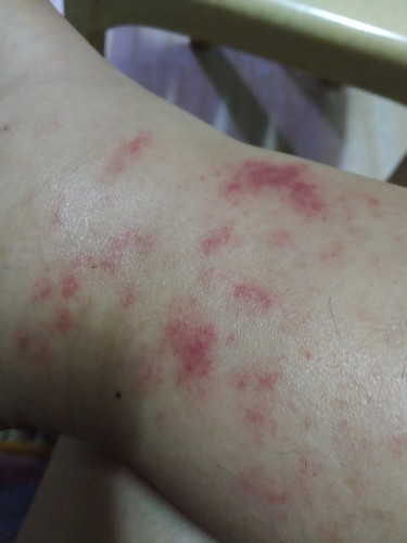 rash or red marks