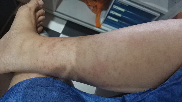 ผื่นคัน คันมาก