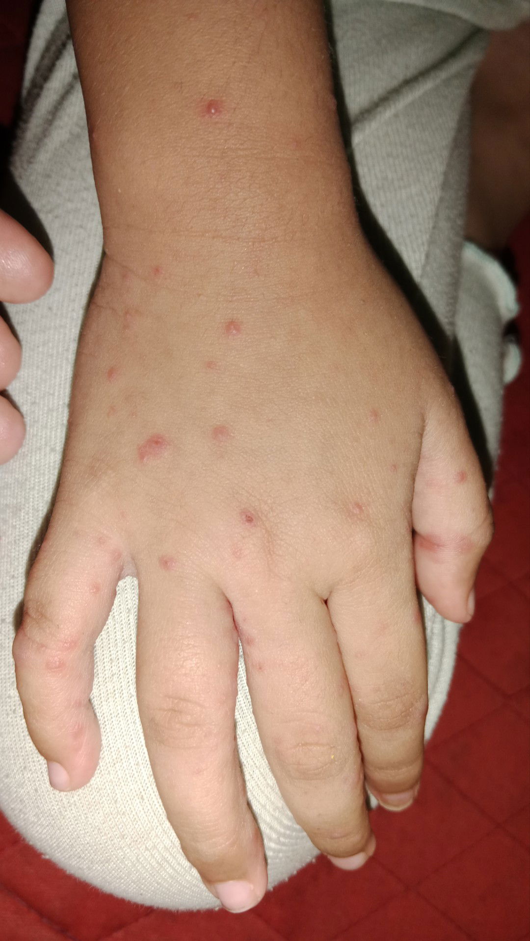 Mam apakah ini cacar air? Kalau iya apa berpengaruh bibir jd seperti sariawan seperti ini?