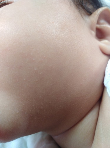 Rashes for baby