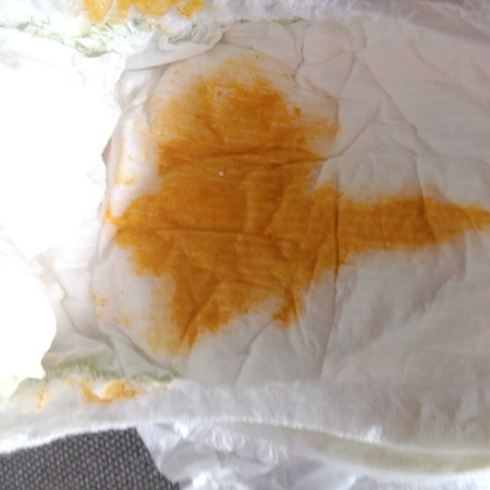 น้องถ่ายแบบนี้ปกติไหม