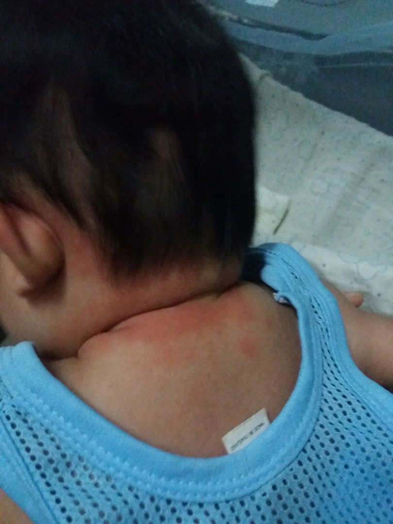 ผดผื่นกับอากาศร้อน