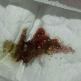 Normal po ba sa bagong silang ang pag pupu ng may halo dugo.?