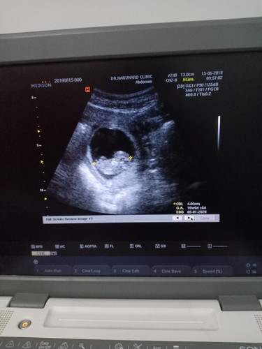 อัลตร้าซาวด์