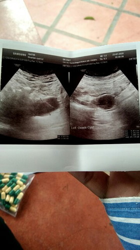 ชีสในรังไข่ด้านซ้าย