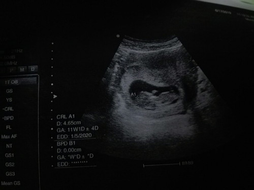 แม่ๆคนไหนตรวจพบเป็นธาลัสซีเมียบ้าง