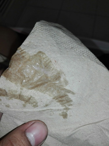 ในรูปคือใช่มูกเลือดรึเปล่าคะแต่มีเลือดออกมานิดเดียวแทบมองไม่ค่อยเห็น