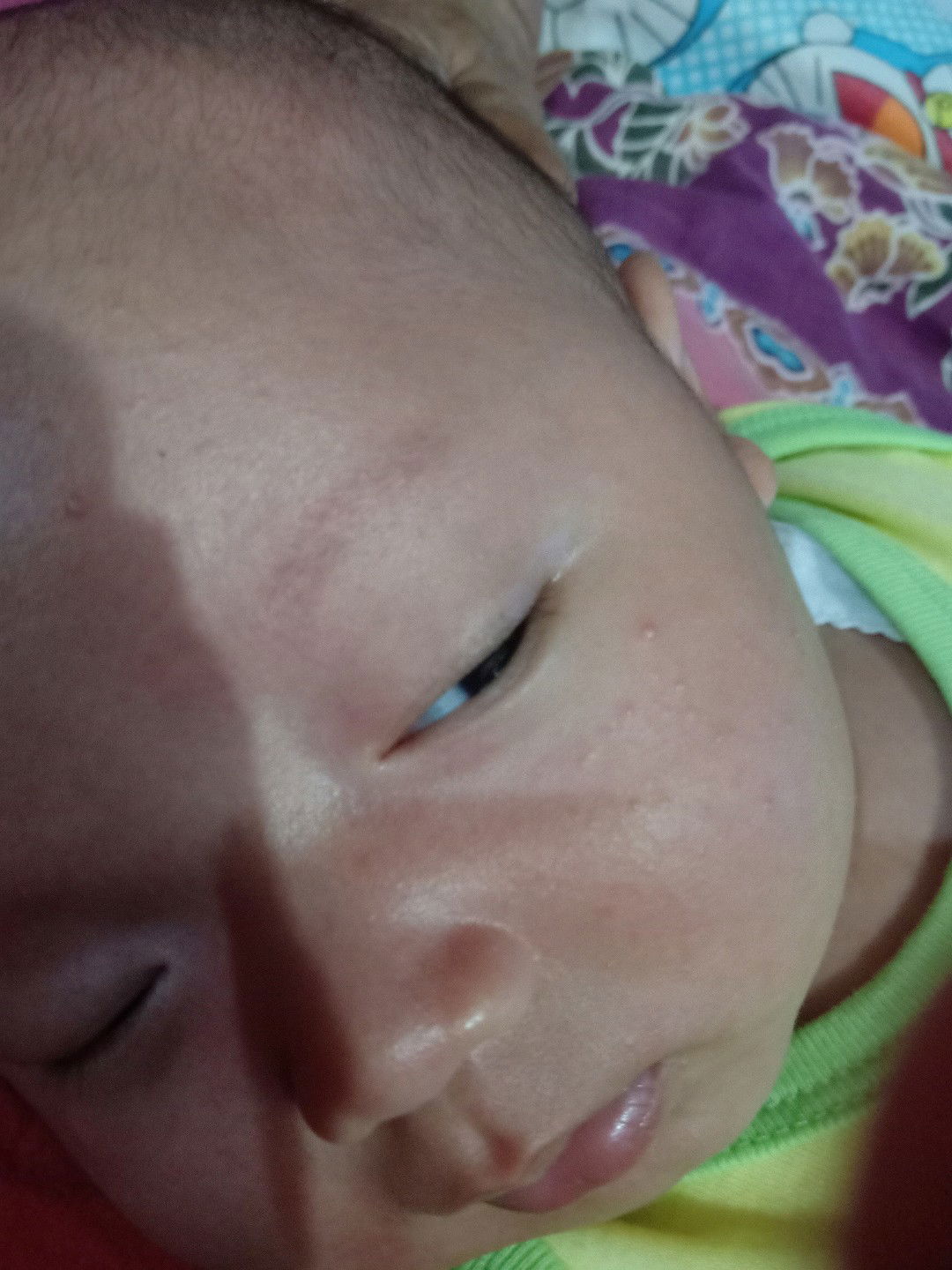 bintik" pada muka bayi