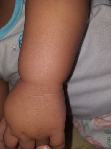 fever w/rashes