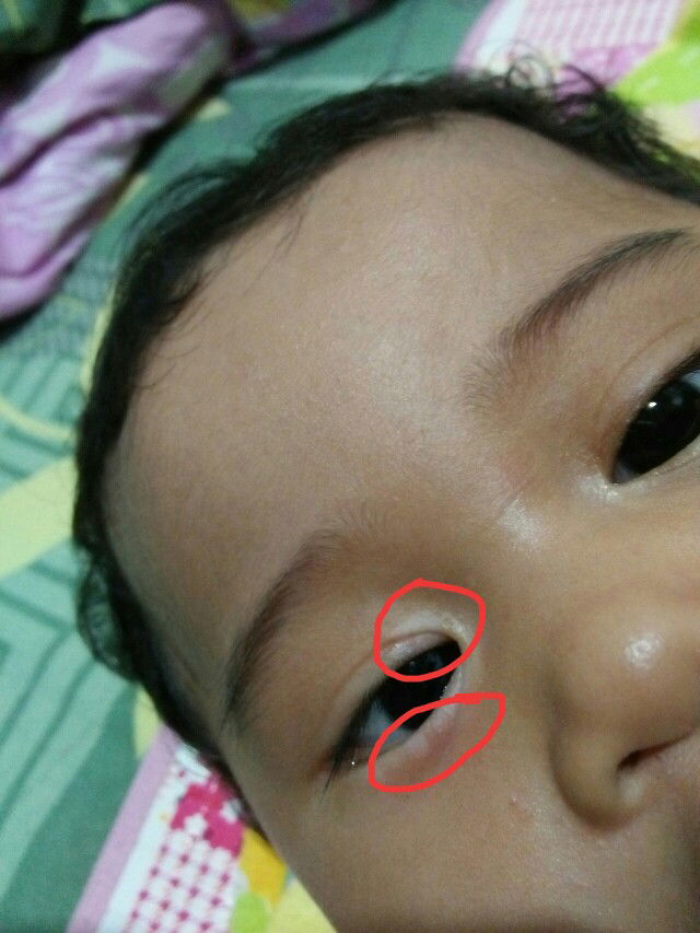 kelopak mata bercak putih