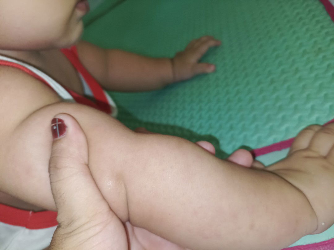 Ruam merah dibandan bayi