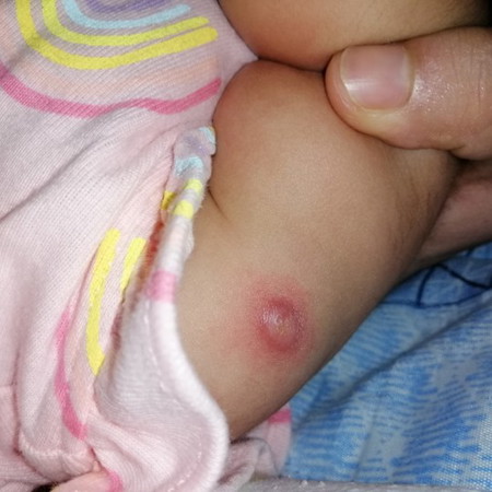 Bcg Vaccine