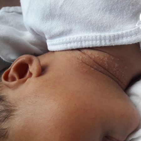 skin problem ni baby