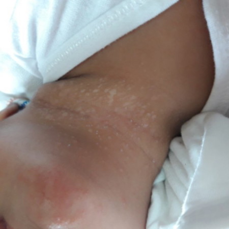 white patches on neck