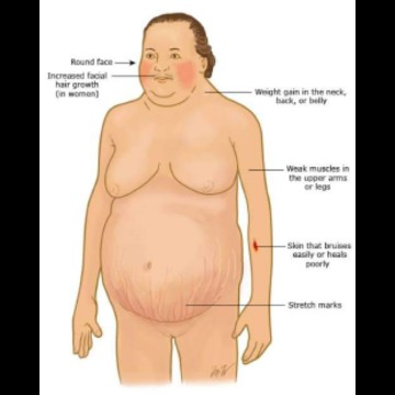 Beware Of Dexamethasone!!!