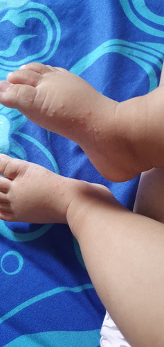 Bintik di kulit anak