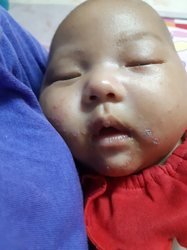 ผื่นขึ้นหน้า