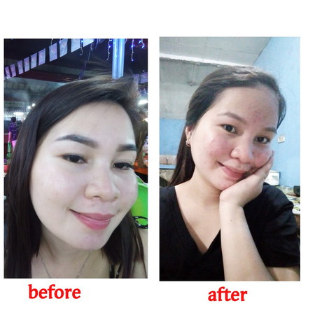 PIMPLES