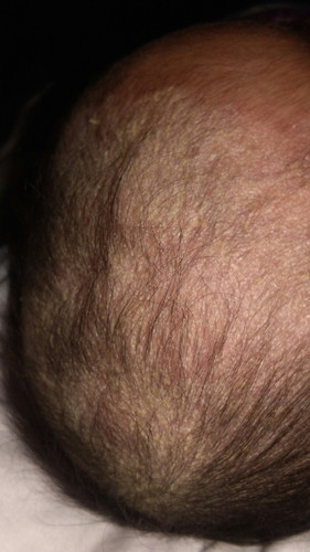cradle cap